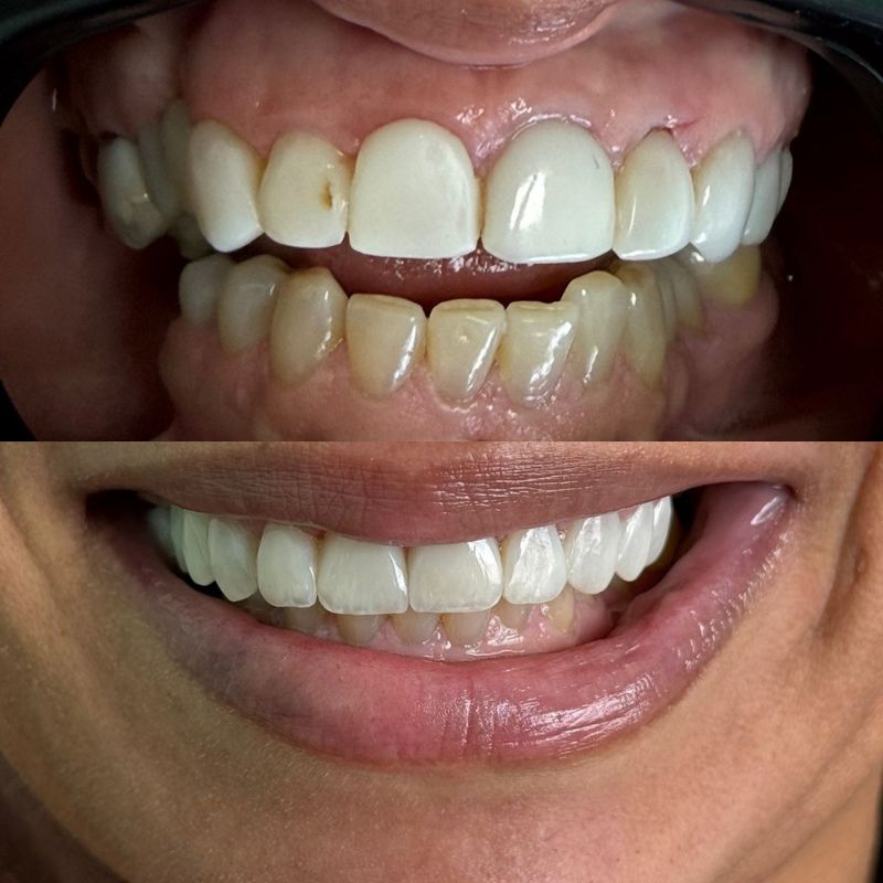 Antes e depois de paciente 1