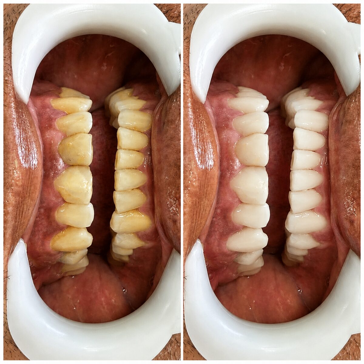 Antes e depois de paciente 1