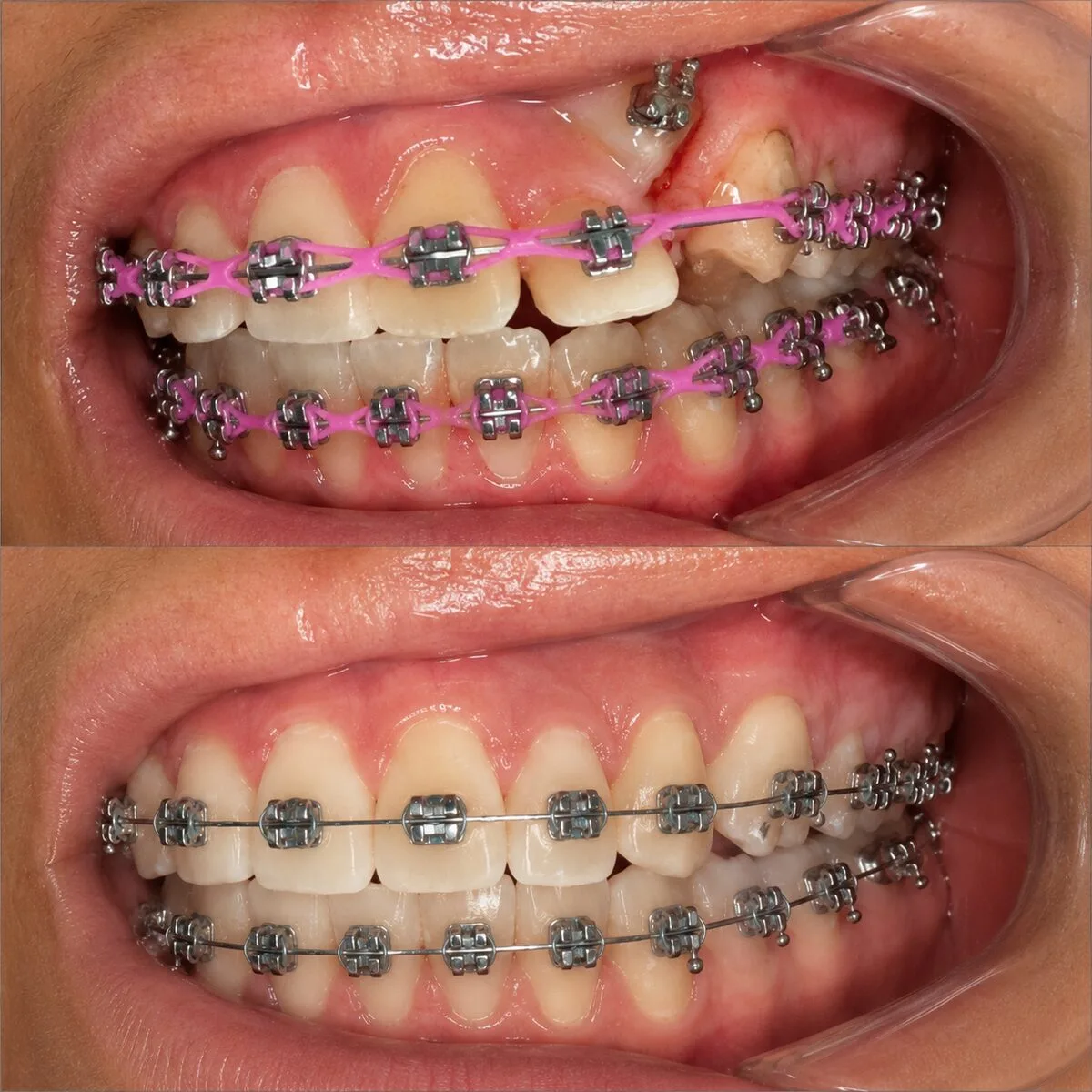 Antes e depois de paciente 2