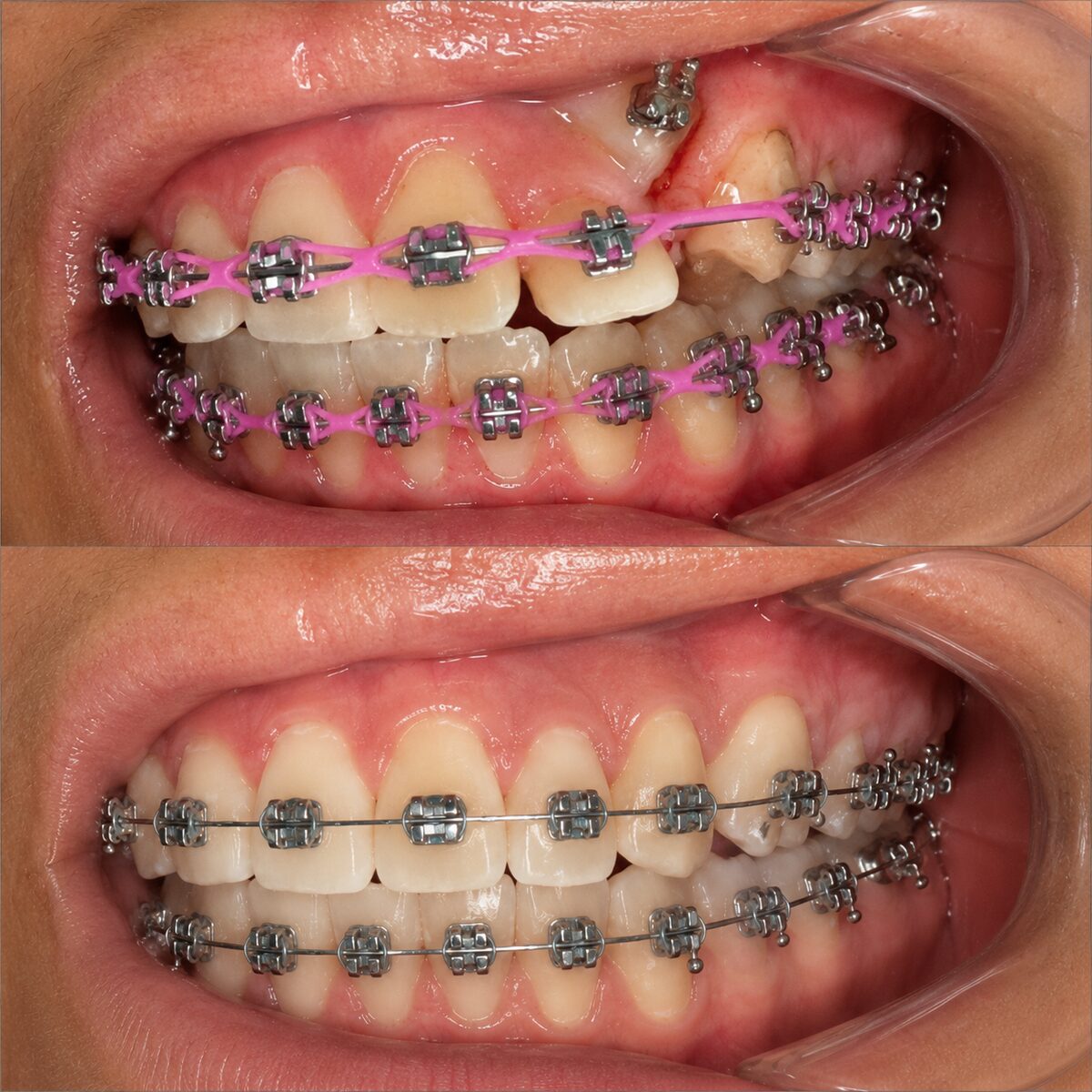 Antes e depois de paciente 2